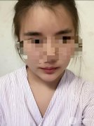 磨腮削骨多少钱 真实磨骨瘦脸案例告诉你