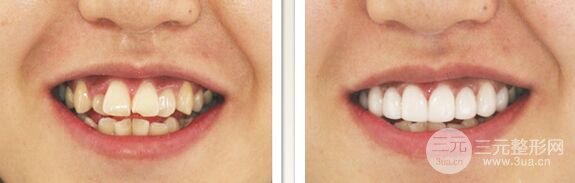 上海成年人牙齿畸形矫正多少钱