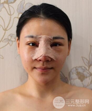 在汉中韩美做了隆鼻整形一个月，恢复越来越自然了