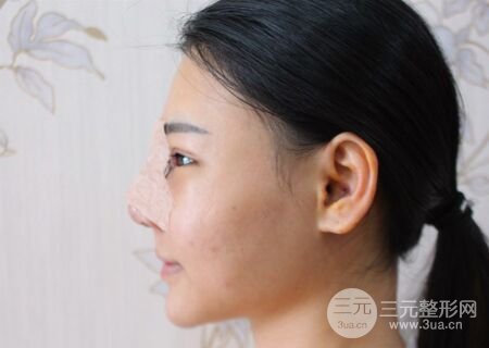 在汉中韩美做了隆鼻整形一个月，恢复越来越自然了
