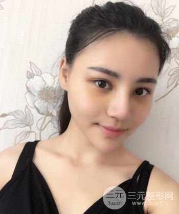 在汉中韩美做了隆鼻整形一个月，恢复越来越自然了