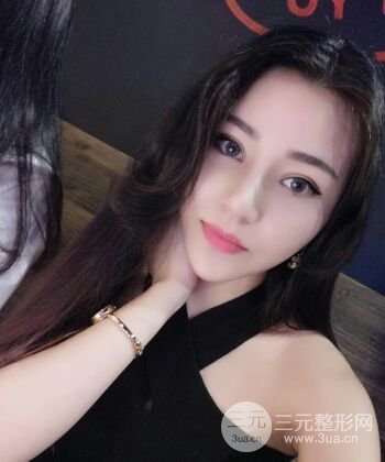 在汉中韩美做了隆鼻整形一个月，恢复越来越自然了