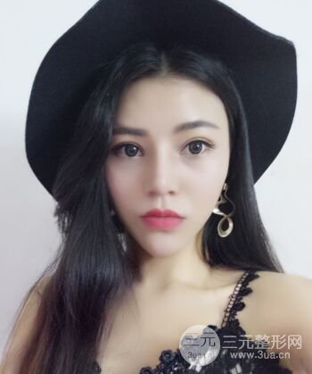 在汉中韩美做了隆鼻整形一个月，恢复越来越自然了