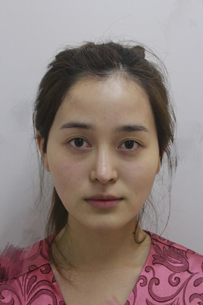 自体脂肪面部填充后成活率超高，少女感十足