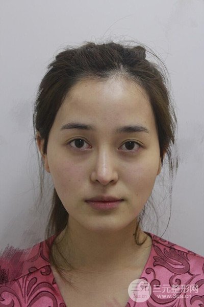 自体脂肪面部填充后成活率超高，少女感十足