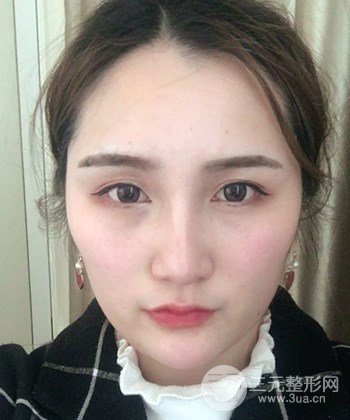 面部埋埋蛋白线.提升前后对比照片，皮肤紧致了不少