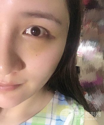 面部埋埋蛋白线.提升前后对比照片，皮肤紧致了不少