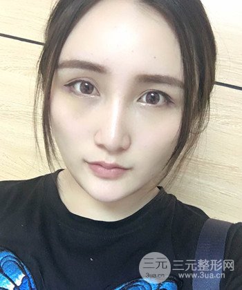 面部埋埋蛋白线.提升前后对比照片，皮肤紧致了不少