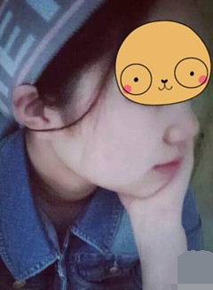 重庆星范丽格手术隆鼻后术后恢复案例图