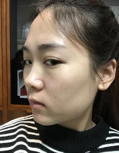 硅胶和耳软骨隆鼻果对比 重庆天艺美隆鼻整形案例