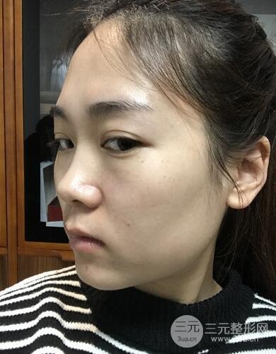 硅胶和耳软骨隆鼻果对比 重庆天艺美隆鼻整形案例