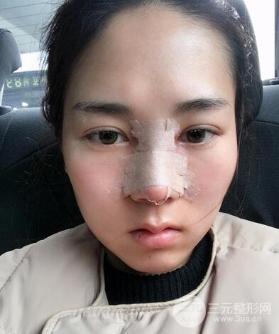 硅胶和耳软骨隆鼻果对比 重庆天艺美隆鼻整形案例
