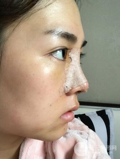 硅胶和耳软骨隆鼻果对比 重庆天艺美隆鼻整形案例
