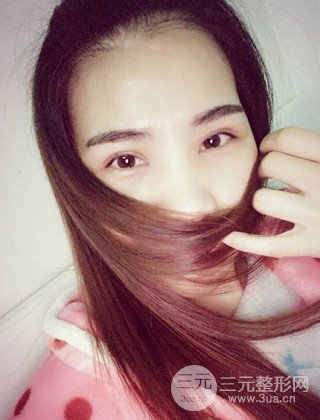 汉中韩美切开双眼皮开眼角恢复对比照片