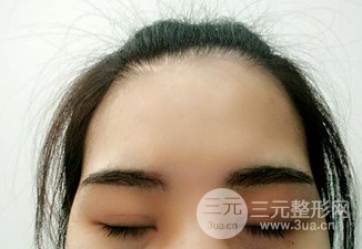 汉中韩美切开双眼皮开眼角恢复对比照片