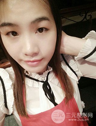 汉中韩美切开双眼皮开眼角恢复对比照片