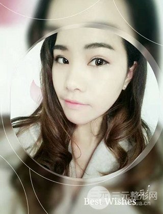 汉中韩美切开双眼皮开眼角恢复对比照片