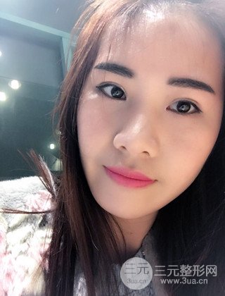 汉中韩美切开双眼皮开眼角恢复对比照片