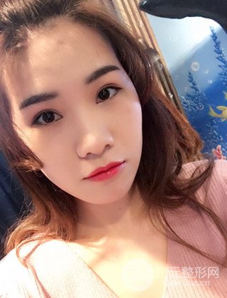 汉中韩美切开双眼皮开眼角恢复对比照片