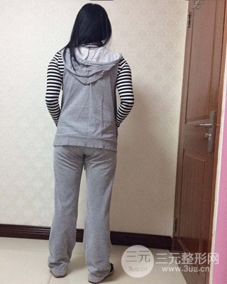 大腿吸脂前后对比照片，南昌永康王忠干真实案例分享