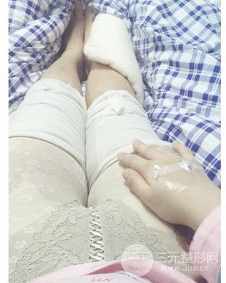 大腿吸脂前后对比照片，南昌永康王忠干真实案例分享