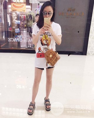 大腿吸脂前后对比照片，南昌永康王忠干真实案例分享