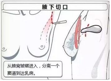 假体隆胸术手术切口优缺点有哪些?