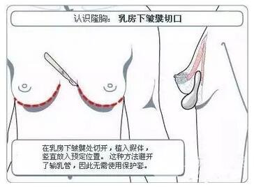 假体隆胸术手术切口优缺点有哪些?