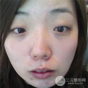 削骨瘦脸手术的价格，真人果图分享