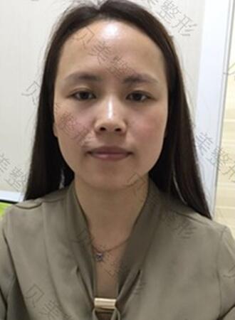 长沙贝美假体隆鼻+耳软骨垫鼻尖+鼻小柱延**果分享