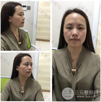 长沙贝美假体隆鼻+耳软骨垫鼻尖+鼻小柱延**果分享