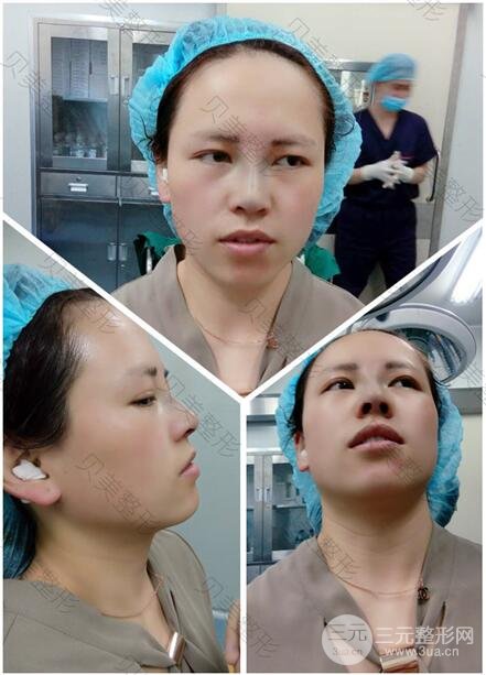 长沙贝美假体隆鼻+耳软骨垫鼻尖+鼻小柱延**果分享