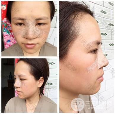 长沙贝美假体隆鼻+耳软骨垫鼻尖+鼻小柱延**果分享