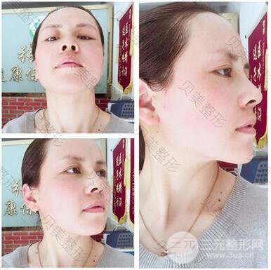 长沙贝美假体隆鼻+耳软骨垫鼻尖+鼻小柱延**果分享