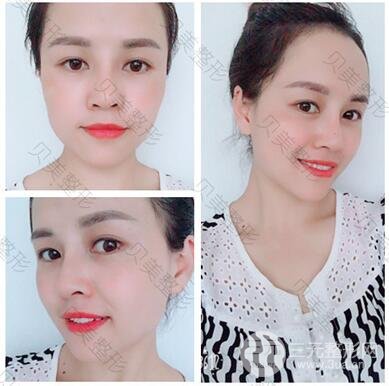 长沙贝美假体隆鼻+耳软骨垫鼻尖+鼻小柱延**果分享