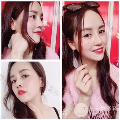 长沙贝美假体隆鼻+耳软骨垫鼻尖+鼻小柱延**果分享