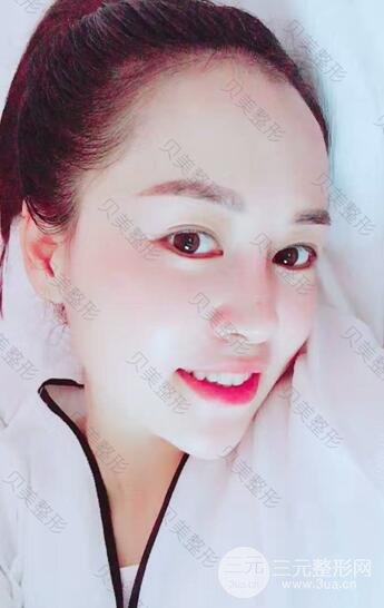 长沙贝美假体隆鼻+耳软骨垫鼻尖+鼻小柱延**果分享