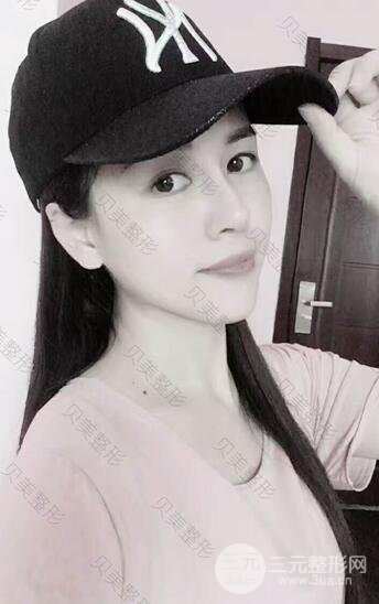 长沙贝美假体隆鼻+耳软骨垫鼻尖+鼻小柱延**果分享