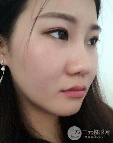 长沙鹏爱隆鼻整形果展示 恢复过程图