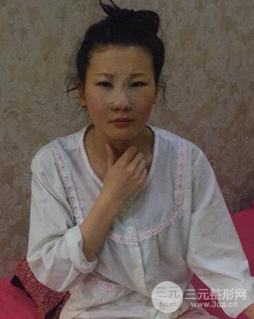 长沙鹏爱隆鼻整形果展示 恢复过程图