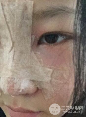 长沙鹏爱隆鼻整形果展示 恢复过程图