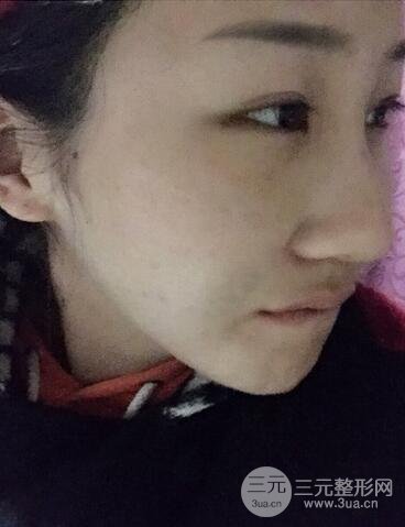 长沙鹏爱隆鼻整形果展示 恢复过程图