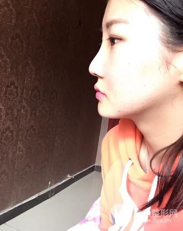 长沙鹏爱隆鼻整形果展示 恢复过程图