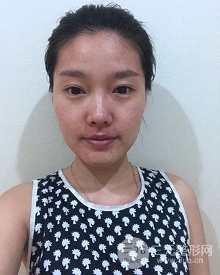 南昌永康整形打水光补水果图前后对比