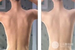 全身光子嫩肤多少钱 朋友去做才花一万五！