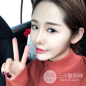 南京米尚恩陈天杰自体脂肪填充全脸 女神的养成记！