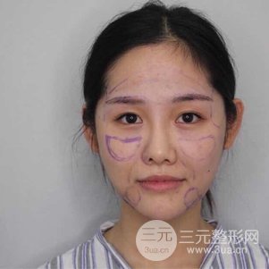 南京米尚恩陈天杰自体脂肪填充全脸 女神的养成记！