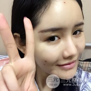 南京米尚恩陈天杰自体脂肪填充全脸 女神的养成记！