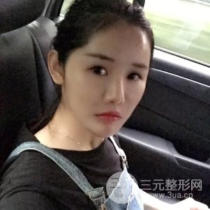 南京米尚恩陈天杰自体脂肪填充全脸 女神的养成记！