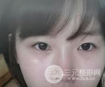 开外眼角前后对比图分享：性感从眼睛开始